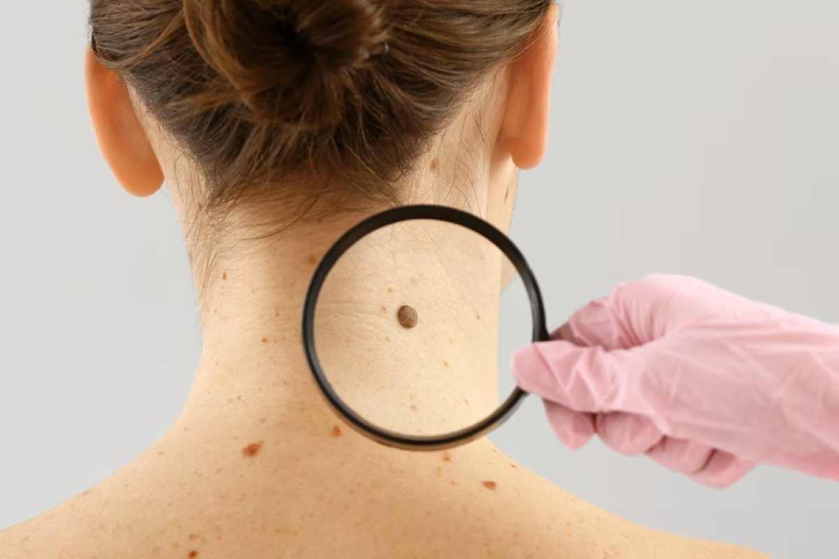 Melanoma, la biopsia liquida prevede le recidive